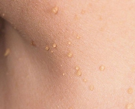 Skin Tags