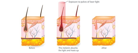 cochrane laser hair removal 2