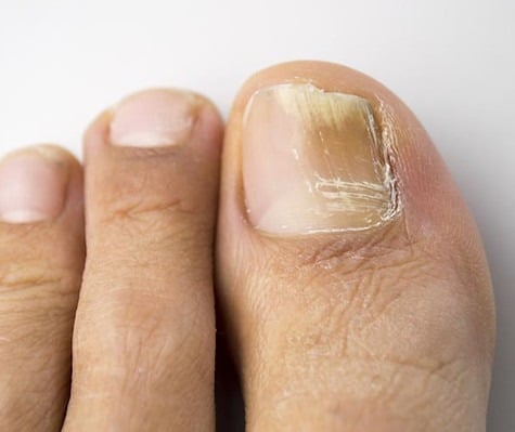 fungal nail infection 750