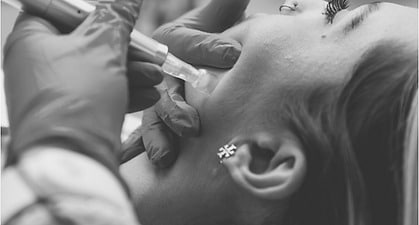 microneedling website