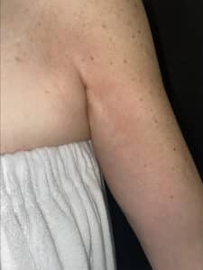 Skin Tightening