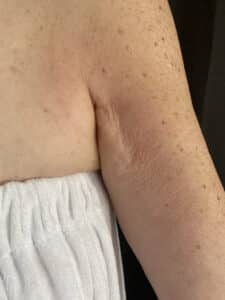 Skin Tightening