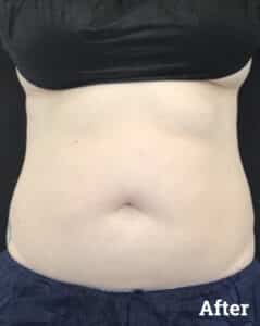 CoolSculpting