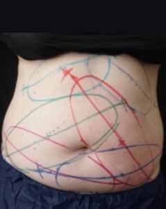 CoolSculpting