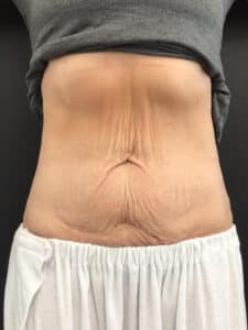 Skin Tightening