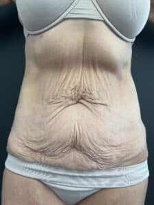 Skin Tightening