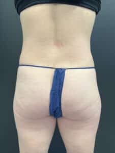 CoolSculpting