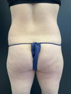 CoolSculpting